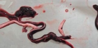 Embalmers Discover Strange, Rubbery ‘Worms’ in Bodies of the Jabbed/ By Free West Media