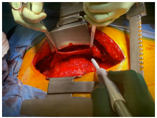 pericarditis