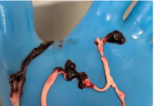 BREAKING STUDY: Anomalous Amyloid Microclots Found in 100% of the COVID-19 Vaccinated/By Nicolas Hulscher, Dr. Charles Hoffe, and Prof Michel Chossudovsky