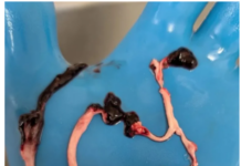 BREAKING: Former President of the Pennsylvania Funeral Directors Association Says 30–40% of Corpses Contain White Fibrous Clots/By Nicolas Hulscher Blue gloved hand holding coiled pink tissue