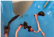 Breaking: International Study Finds 75% of Embalmers Observed White Fibrous Clots in Corpses/By Nicolas Hulscher
